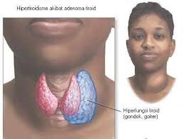 obat hipertiroid